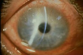 Image result for Chlamydia Trachomatis Eyes