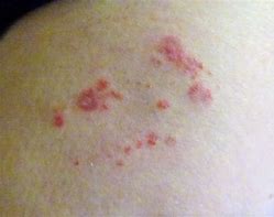 Image result for Shingles On Thigh