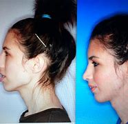 Image result for Jaw Surgery Procedure