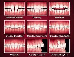 Image result for Correcting Overbite