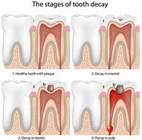 Image result for Rotten Tooth Root