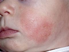 Image result for Rash around Mouth Child
