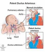 Image result for PDA Disease
