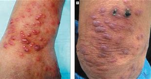 Image result for Nodule Skin Lesion