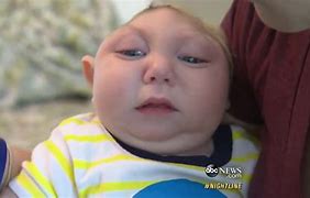 Image result for Baby Born without a Brain S