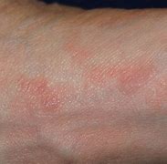 Image result for Crusted Scabies Rash