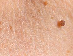 Image result for Blood Skin Tags