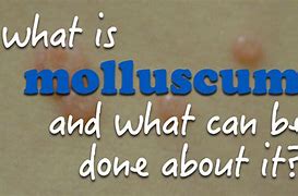 Image result for Treating Molluscum