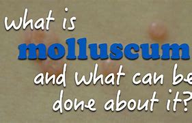 Image result for Molluscum Papules