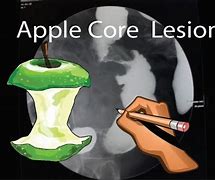 Image result for Apple Core Sign Esophagus