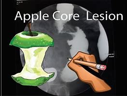 Image result for Apple Core Lesion