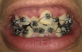 Image result for Messed Up Teeth with Braces