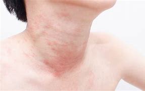 Image result for Itchy Skin Rash On Neck
