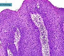 Image result for Laryngeal Papilloma