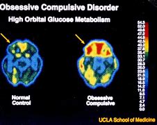 Image result for Brain Scans of People with OCD