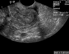 Image result for carcinoma_endometrium
