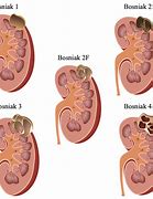 Image result for Cystic Lesion Kidney