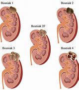Image result for Complex Cyst On Kidney
