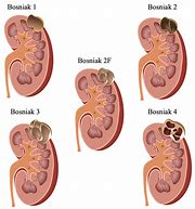 Image result for Upper Pole Kidney Cyst