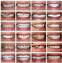 Image result for Crooked Teeth Before and After Braces
