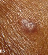 Image result for Molluscum Groin