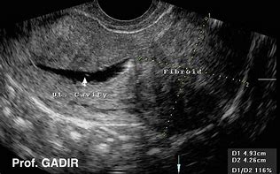 Image result for Cervical Fibroid Ultrasound