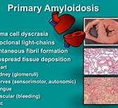 Image result for Raccoon Eyes Amyloidosis