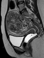 Image result for Fibroid Uterus MRI