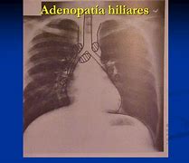 Image result for adenopat�a