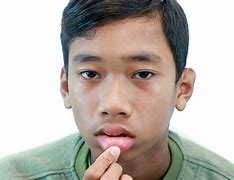 Image result for Swollen Lips Allergic Reaction
