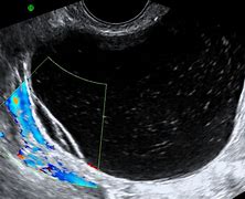 Image result for Ovarian Cystadenoma Ultrasound