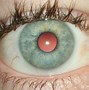Image result for Off-Center Contact Lens