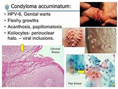 Image result for Condyloma STD