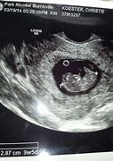 Image result for 9 Weeks 5 Days Ultrasound