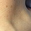 Image result for Warts and Skin Tags