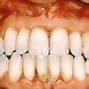 Image result for Gingival Cancer Pictures