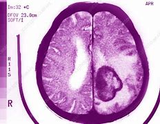 Image result for Papilloma Brain Tumor