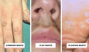 Image result for Types of Warts On Back