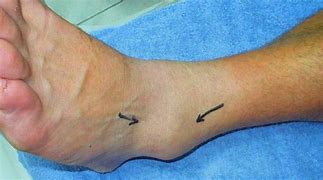 Image result for Foot and Ankle Pain