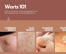 Image result for Dermal Warts