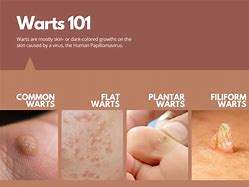 Image result for Wart Virus