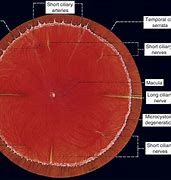 Image result for Hole in Retina