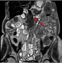 Image result for Small Bowel Carcinoid Tumor