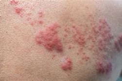 Image result for Stages of Shingles Healing