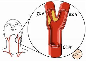 Image result for Carotid Artery In-Stent Stenosis