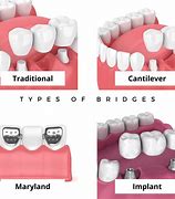 Image result for 4 Types of Dental Bridge