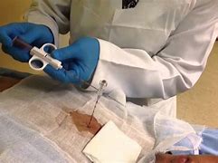 Image result for Lung Mass Biopsy