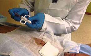 Image result for Biopsy On Lung Nodule