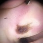 Image result for Abnormal Moles