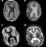 Image result for Brain Premature Sulcaation Ultrasound